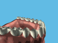 Gum Disease Animation